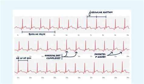 av junction box|av junctional rhythm.